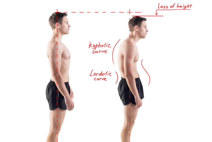 How Correcting Your Posture Will Improve Your General Wellness