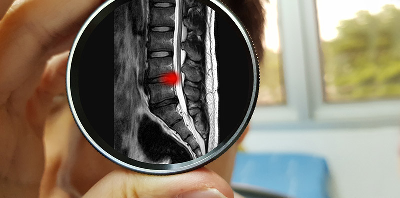 The Effects Of Physiotherapy On A Herniated Disc